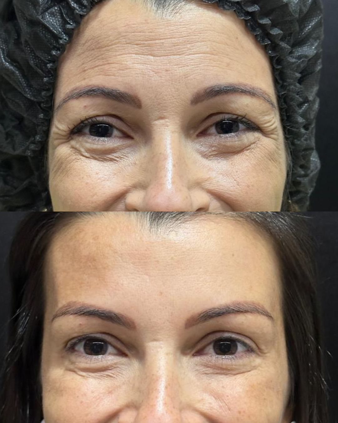 Antes e Depois - Toxina Botulínica Região dos Olhos