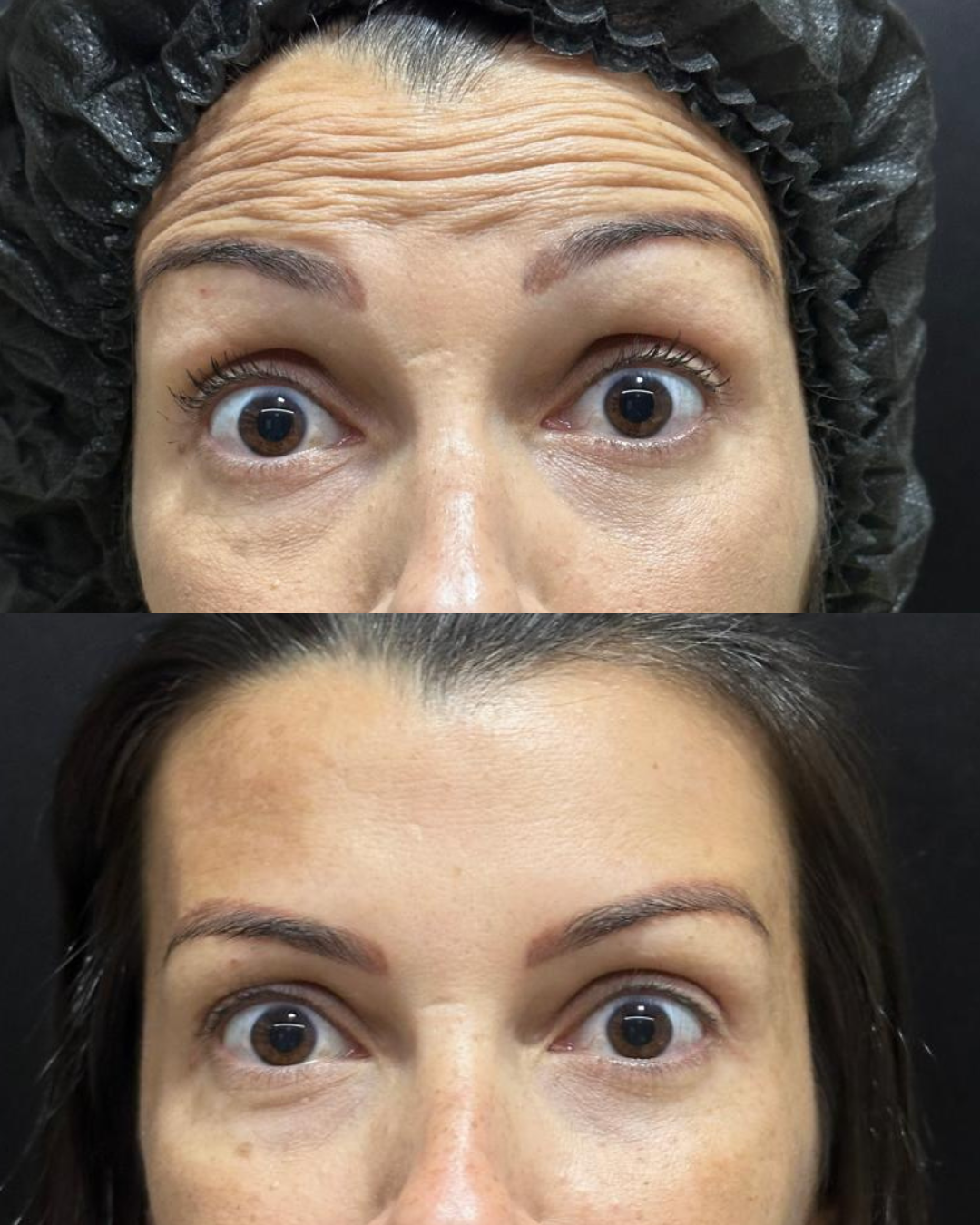 Antes e Depois - Toxina Botulínica Testa