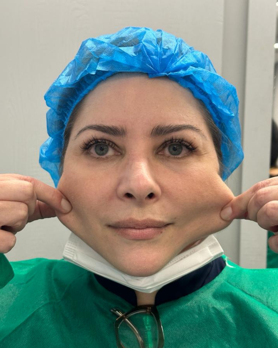 Antes e Depois - Ultrassom Microfocado Contorno Facial