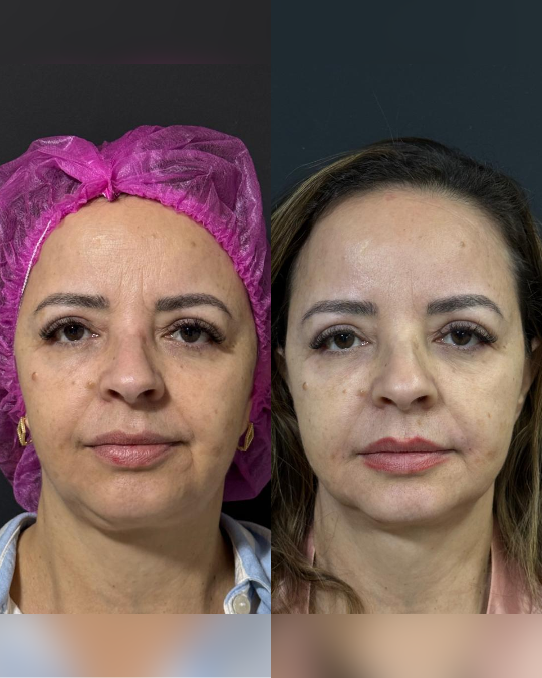 Antes e Depois - Ultrassom Microfocado Face