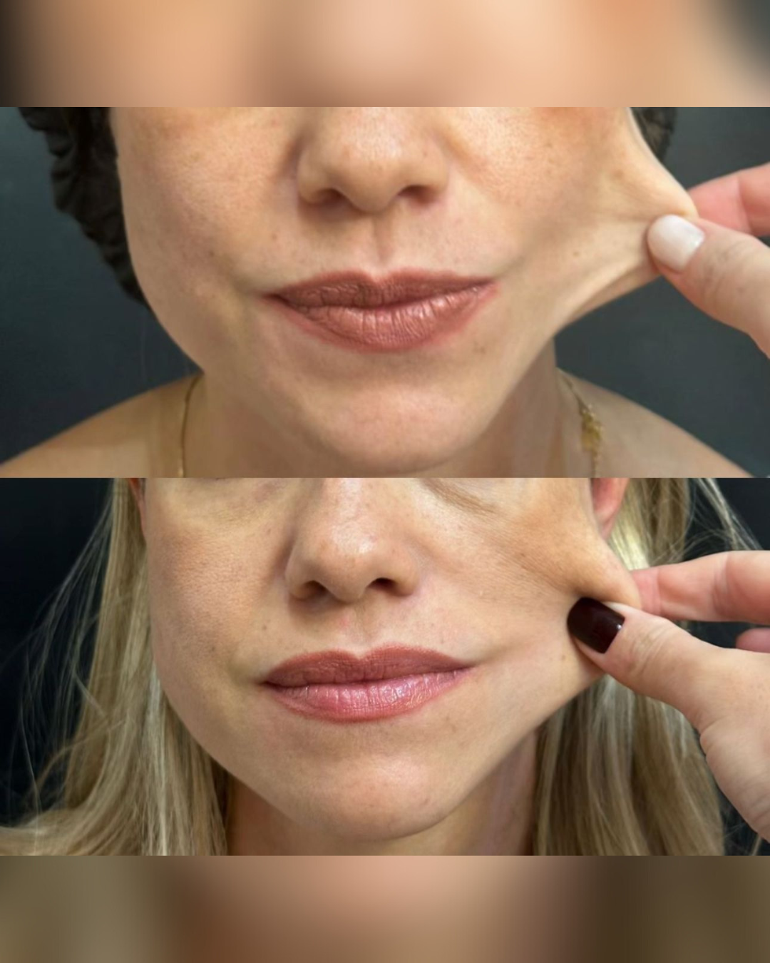 Antes e Depois - Ultrassom Microfocado Linha da Mandíbula