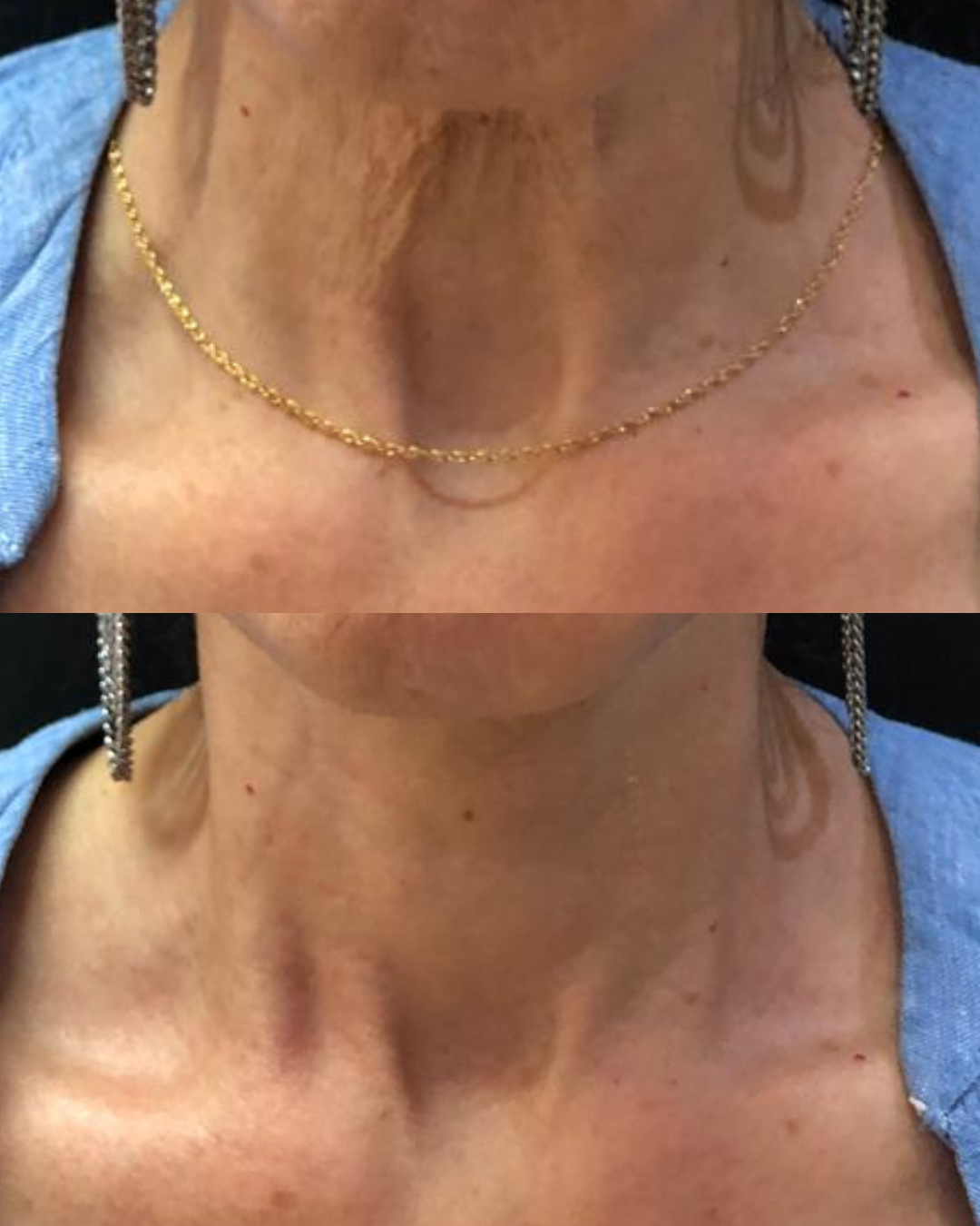 Antes e Depois - Ultrassom Microfocado Pescoço