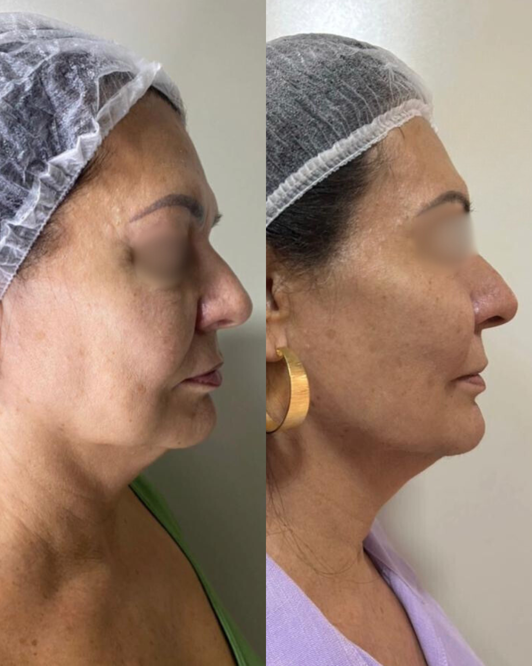 Antes e Depois - Ultrassom Microfocado Perfil Lateral