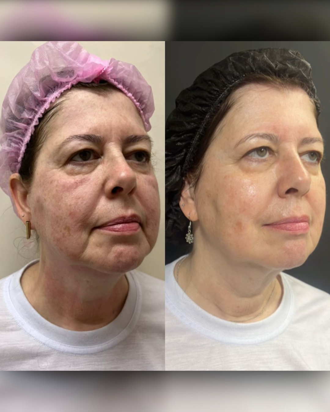 Antes e Depois - Ultrassom Microfocado Perfil